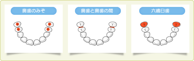 奥歯のみぞ／奥歯と奥歯の間／六歳臼歯