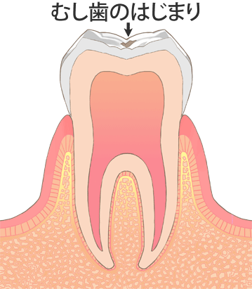 C0:むし歯のはじまり