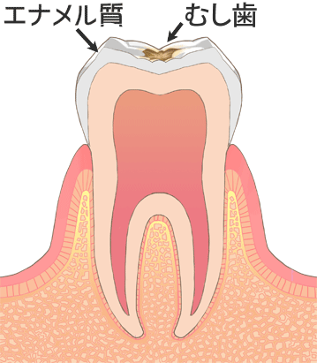 C1:エナメル質のむし歯