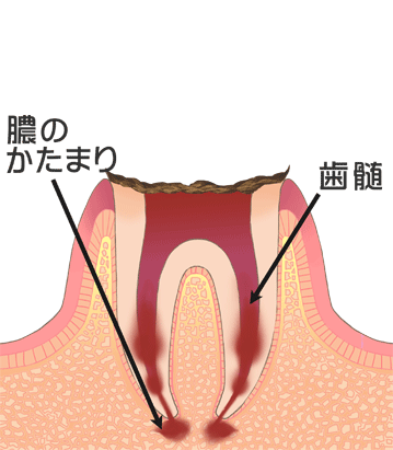 C4:歯根だけ残ったむし歯