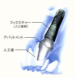 歯を失ってお悩みの方へ