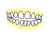 空隙歯列（すきっ歯）