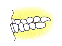 反対咬合（受け口）
