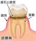 C1:エナメル質のむし歯