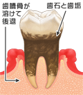 C3:神経にまで進んだむし歯